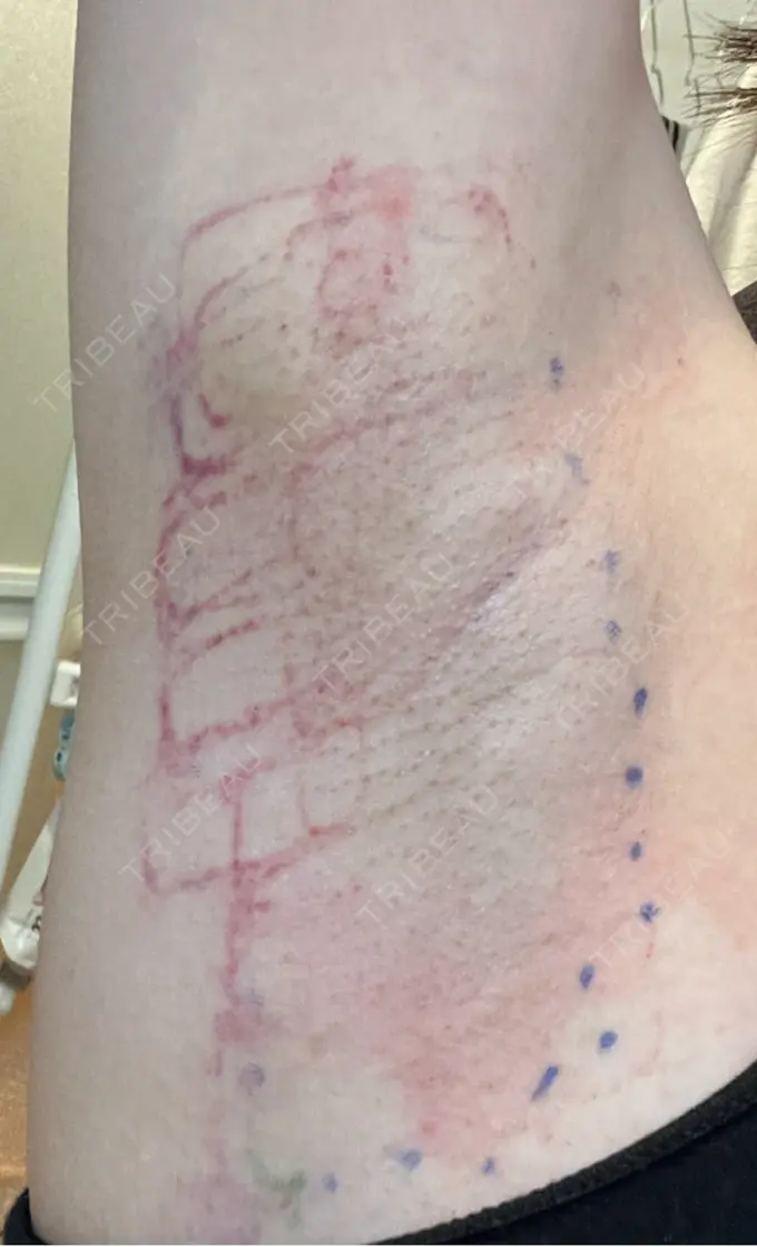 ワキ汗治療（レーザー） ルラ美容クリニック 渋谷本院 DAY 0 メイン用