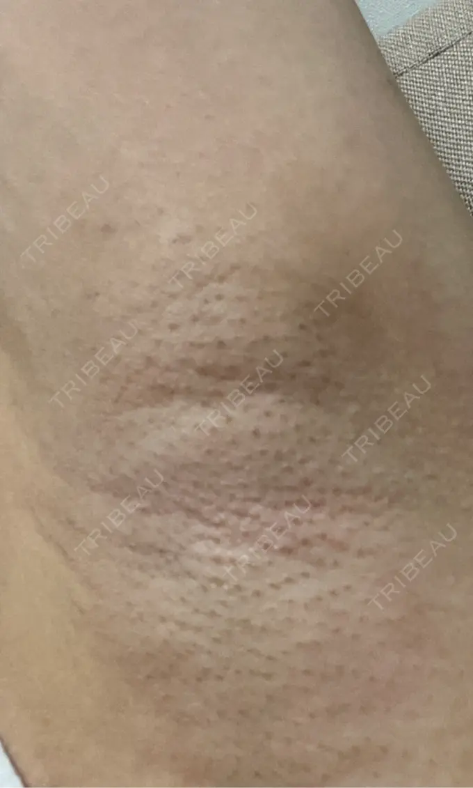 ワキ汗治療（レーザー） ルラ美容クリニック 渋谷本院 AFTER メイン用