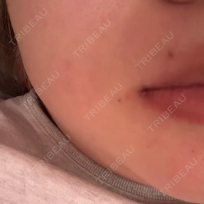 ほくろ・いぼ切除（肌） R Beauty CLINIC 名古屋院 DAY 6 メイン用