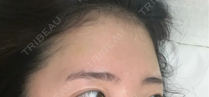 肌育注射（ジュベルックなど） ゆきスキンクリニック 東池袋 DAY 4 メイン用