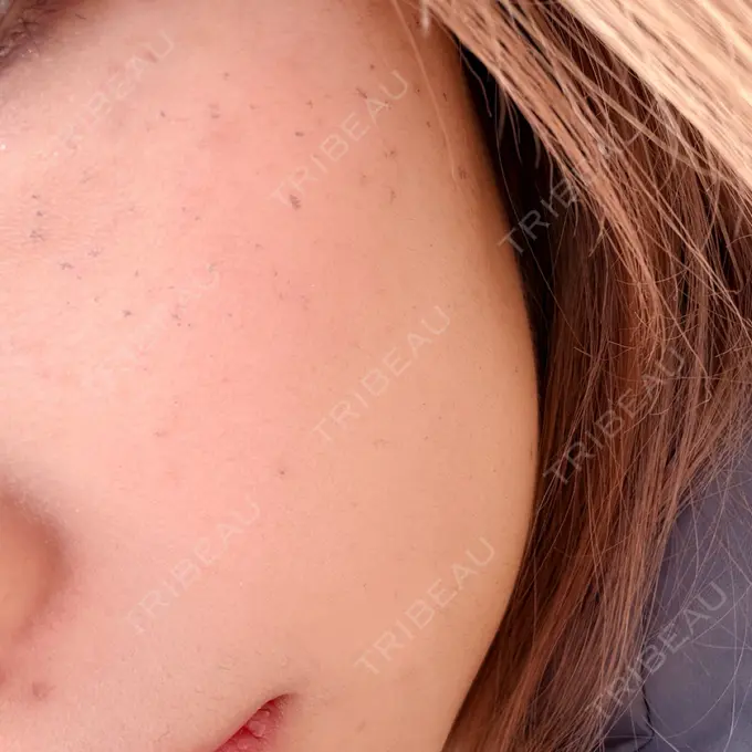 ルメッカ 博多美容外科/美容皮膚科 ビラビューティークリニック DAY 5 メイン用