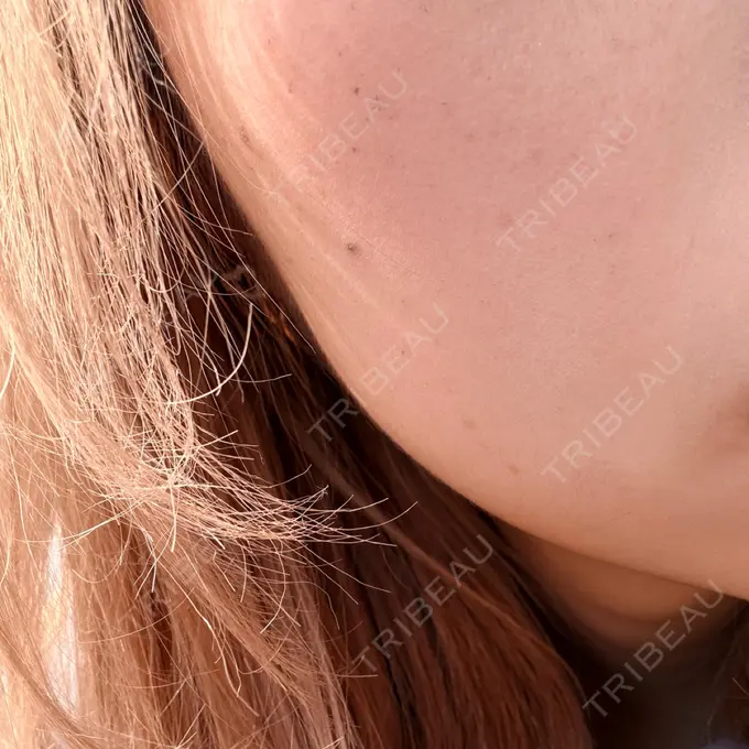 ルメッカ 博多美容外科/美容皮膚科 ビラビューティークリニック DAY 5 メイン用