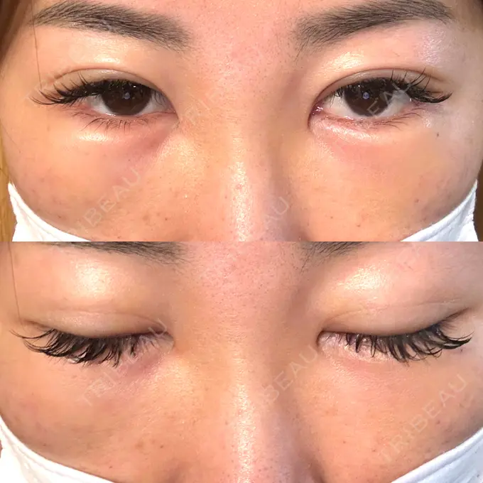 クマ治療 / 脂肪注入（目の下） / その他（口元） 湘南美容クリニック 千葉センシティ院 DAY 2 メイン用