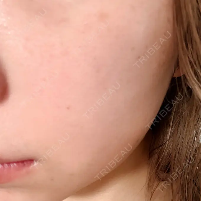 ルメッカ 博多美容外科/美容皮膚科 ビラビューティークリニック DAY 6 メイン用