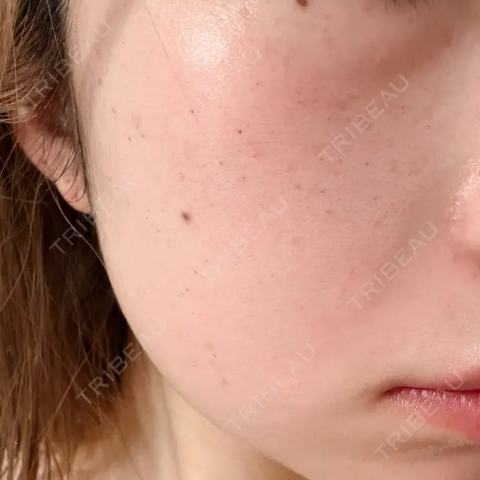 ルメッカ 博多美容外科/美容皮膚科 ビラビューティークリニック DAY 6 メイン用