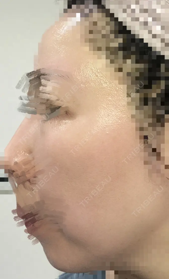 ルビーレーザー AZ BEAUTY CLINIC DAY 9 メイン用