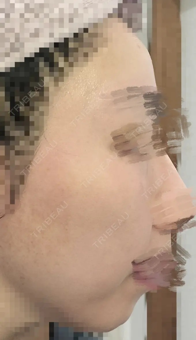 ルビーレーザー AZ BEAUTY CLINIC DAY 9 メイン用