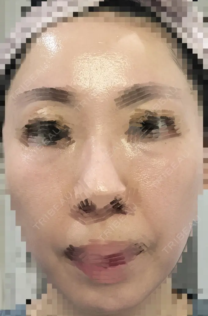 ルビーレーザー AZ BEAUTY CLINIC DAY 9 メイン用