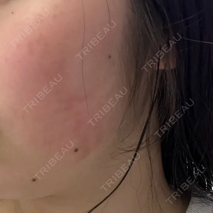 インモード 東京美容皮膚科アロエクリニック池袋 DAY 5 メイン用