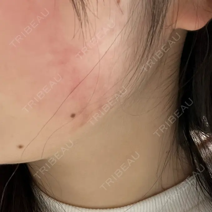 インモード 東京美容皮膚科アロエクリニック池袋 DAY 4 メイン用