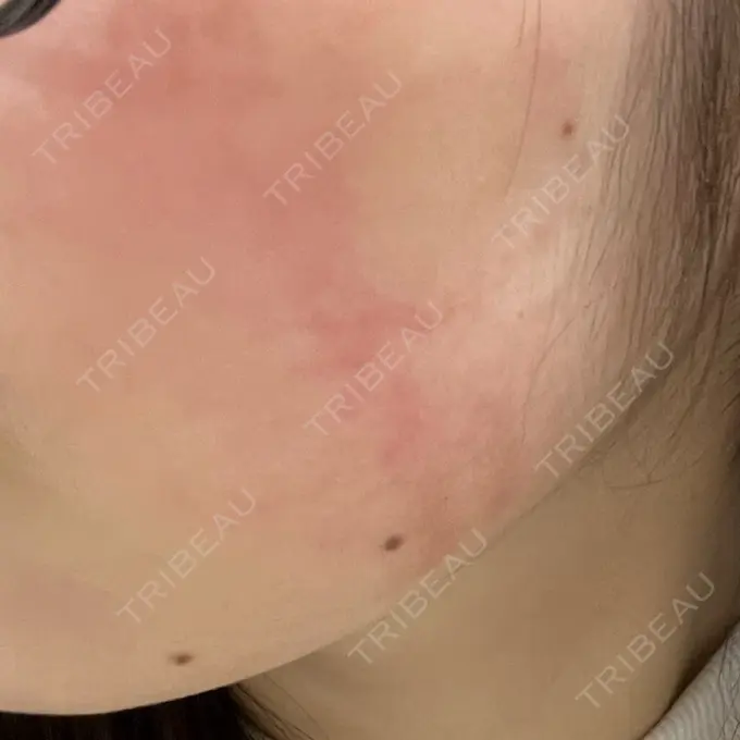 インモード 東京美容皮膚科アロエクリニック池袋 DAY 7 メイン用