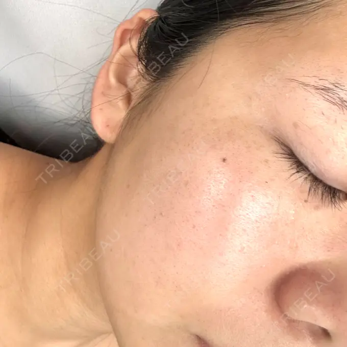 ルメッカ 博多美容外科/美容皮膚科 ビラビューティークリニック AFTER メイン用