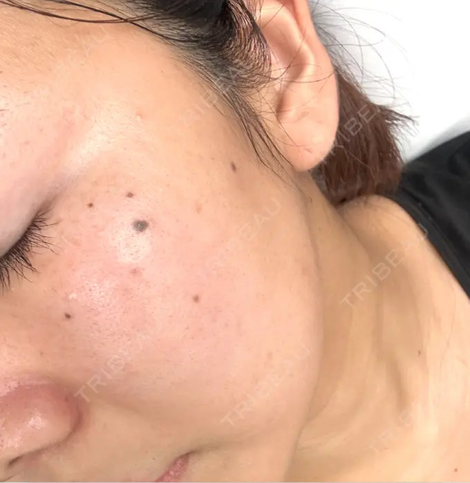 ルメッカ 博多美容外科/美容皮膚科 ビラビューティークリニック DAY 6 メイン用