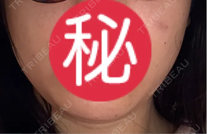 オンダリフト LIGHT CLINIC 【ライトクリニック】 名古屋院 AFTER メイン用