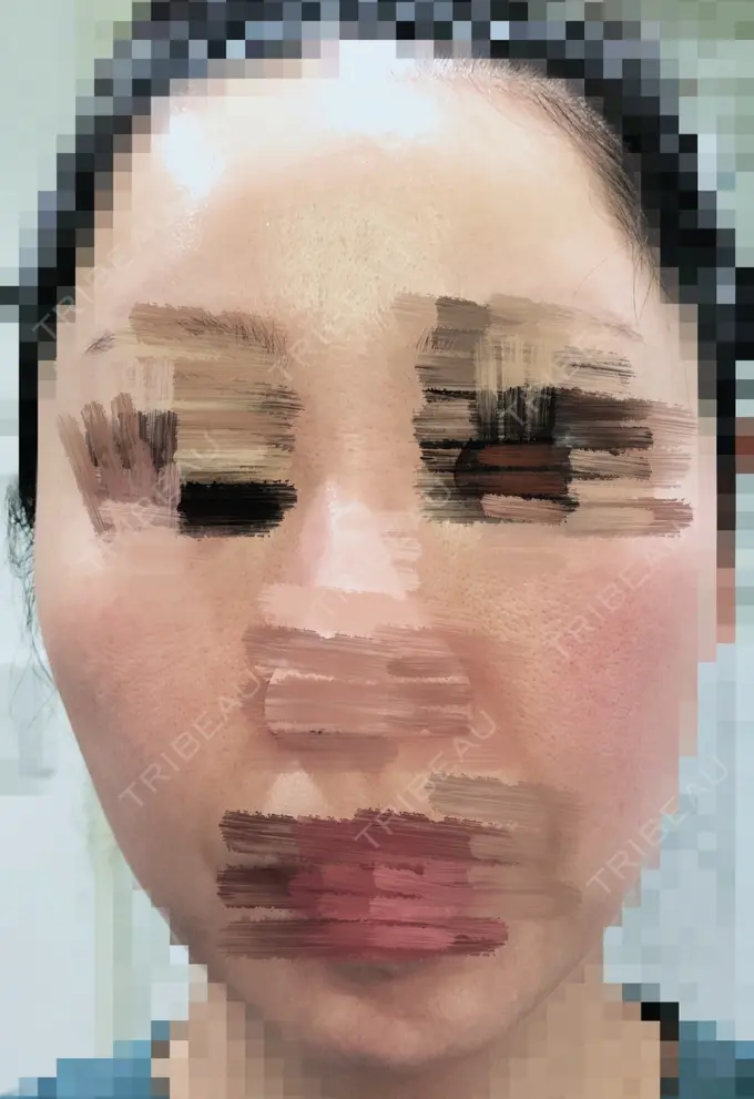 ルビーレーザー AZ BEAUTY CLINIC DAY 10 メイン用