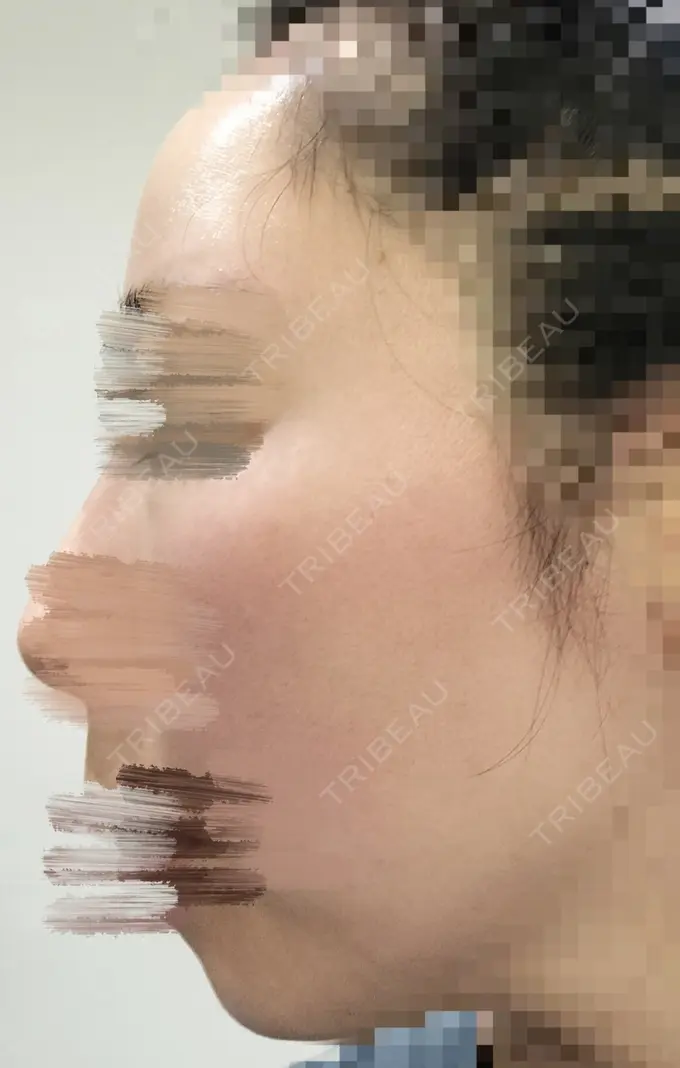 ルビーレーザー AZ BEAUTY CLINIC DAY 10 メイン用