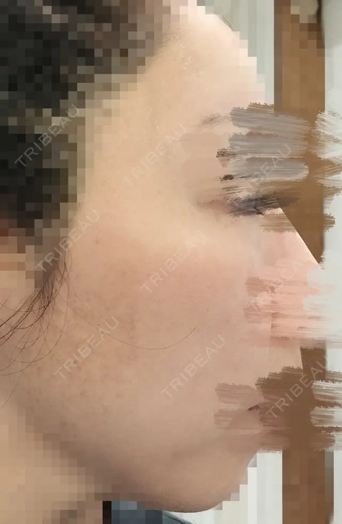 ルビーレーザー AZ BEAUTY CLINIC DAY 10 メイン用