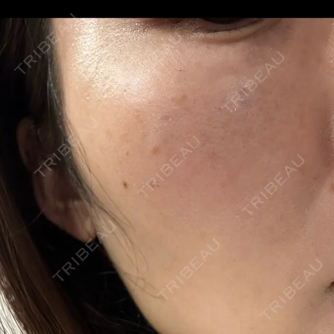 スネコス ルラ美容クリニック 仙台院 / ルラスキンクリニック 仙台院 DAY 35 メイン用