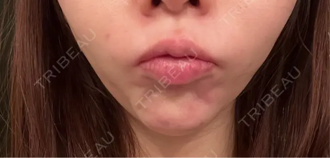 ボトックス（あご） 湘南美容クリニック 名古屋院 DAY 2 メイン用