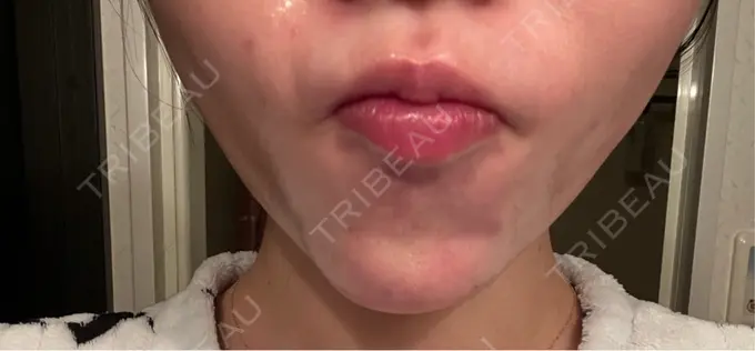 ボトックス（あご） 湘南美容クリニック 名古屋院 DAY 3 メイン用