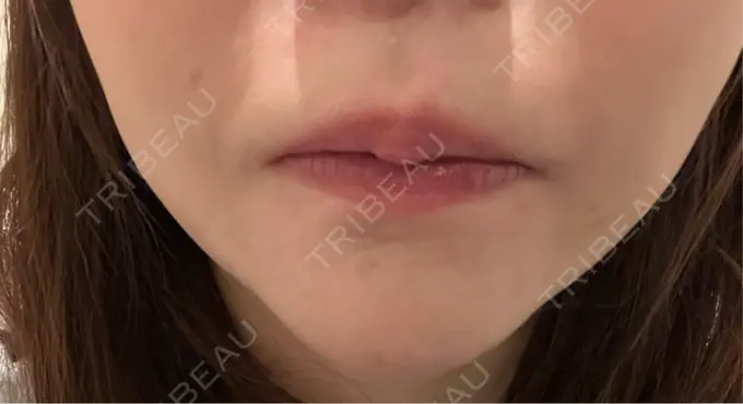 ボトックス（あご） 湘南美容クリニック 名古屋院 DAY 4 メイン用