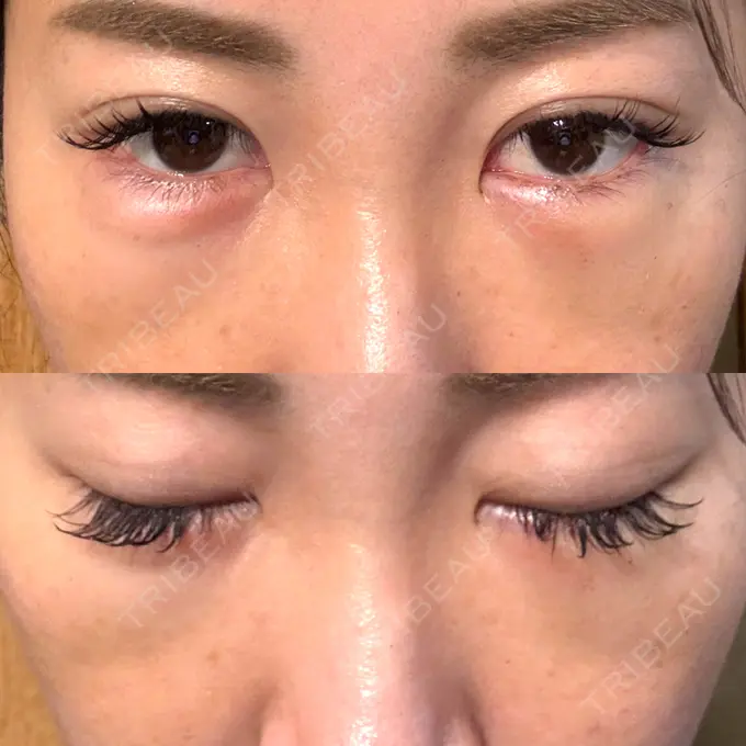 クマ治療 / 脂肪注入（目の下） / その他（口元） 湘南美容クリニック 千葉センシティ院 DAY 4 メイン用