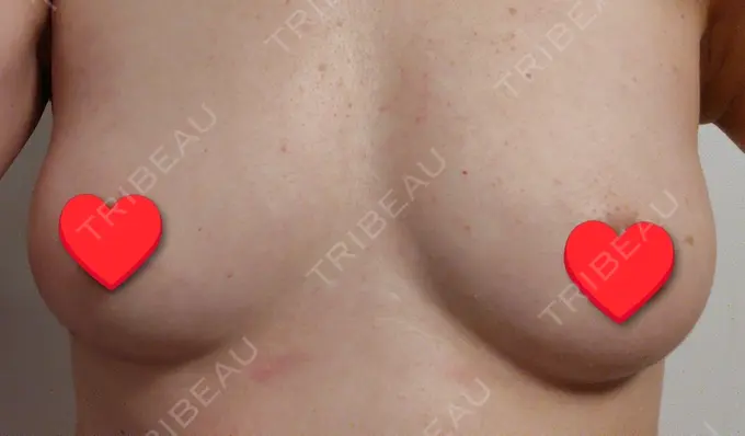 豊胸（脂肪注入） 湘南美容クリニック Regno 銀座院 AFTER メイン用