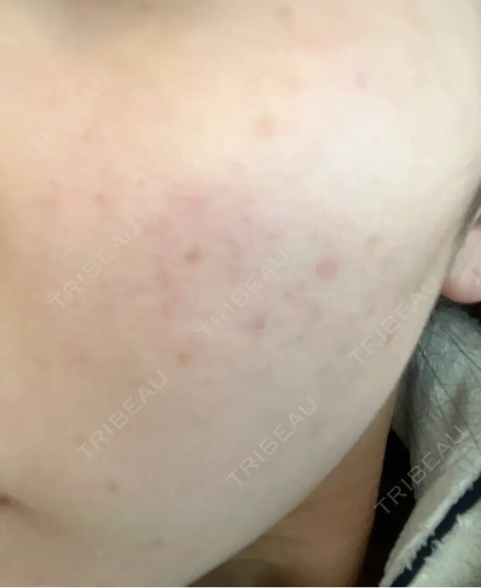 光治療（フォトフェイシャルなど） Fellez Clinic【フェルズクリニック】 AFTER メイン用