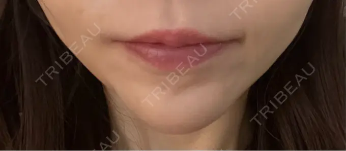 ボトックス（あご） 湘南美容クリニック 名古屋院 DAY 5 メイン用