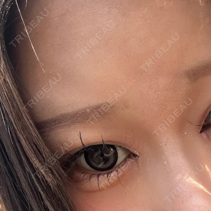 ヒアルロン酸注入（涙袋） 博多美容外科/美容皮膚科 ビラビューティークリニック AFTER メイン用