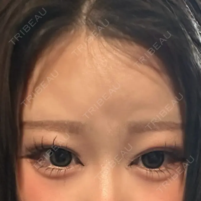 ヒアルロン酸注入（涙袋） 博多美容外科/美容皮膚科 ビラビューティークリニック DAY 1 メイン用