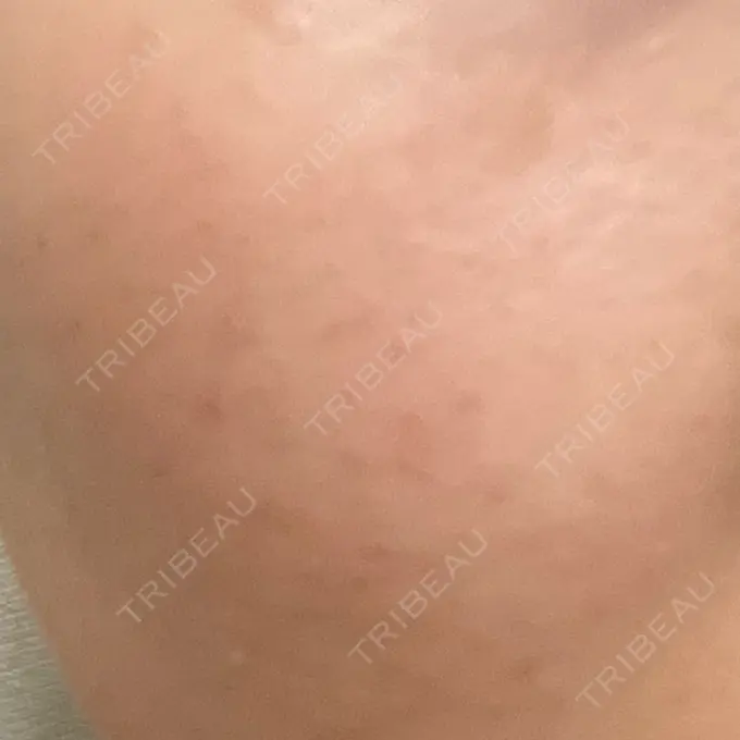 ルメッカ ルラ美容クリニック 岡山院 AFTER メイン用