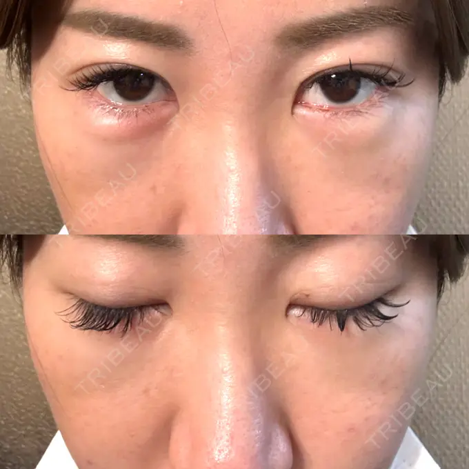 クマ治療 / 脂肪注入（目の下） / その他（口元） 湘南美容クリニック 千葉センシティ院 DAY 5 メイン用