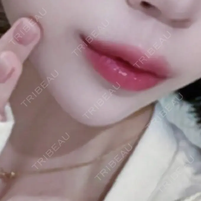 ヒアルロン酸注入（唇） 目白ホワイトクリニック AFTER メイン用