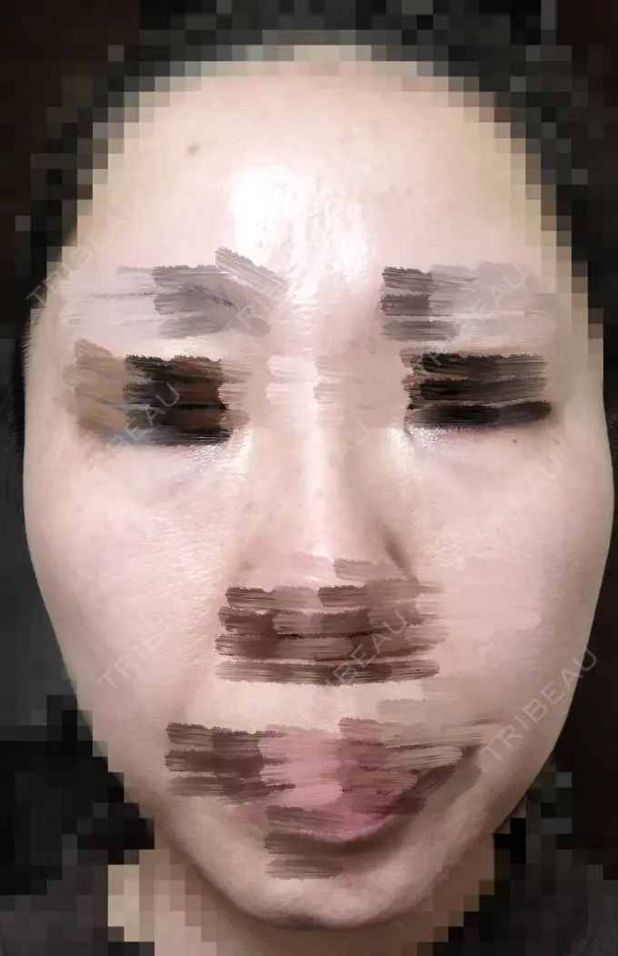 ルビーレーザー AZ BEAUTY CLINIC DAY 11 メイン用