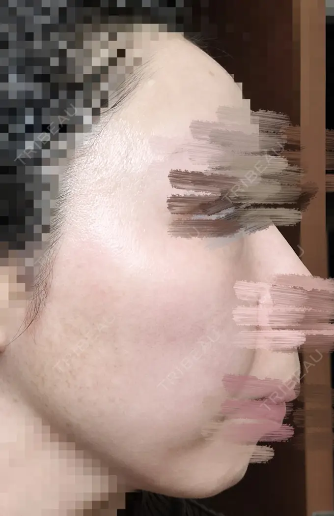 ルビーレーザー AZ BEAUTY CLINIC DAY 11 メイン用