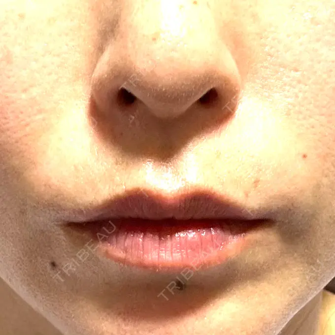 肌ヒアルロン酸注入（たるみ・シワ改善） NARU Beauty Clinic 【ナルクリ】 水戸院 AFTER メイン用