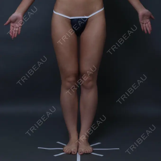 脂肪吸引（脚） THE CLINIC（ザ・クリニック） 名古屋院 DAY 32 メイン用