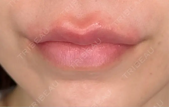 ヒアルロン酸注入（唇） / ボトックス（口角） ルラ美容クリニック 大阪本院 AFTER メイン用