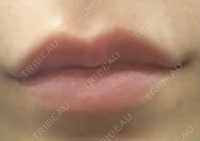 ヒアルロン酸注入（唇） / ボトックス（口角） ルラ美容クリニック 大阪本院 DAY 21 メイン用