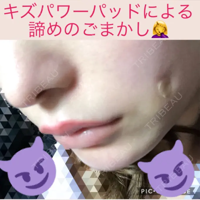 その他（輪郭） / その他（口元） / その他 ドクターゴールドマンクリニック 東京高輪院 DAY 5 メイン用