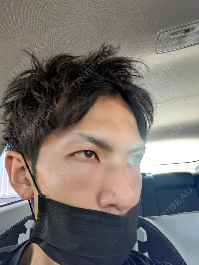 クマ治療 ネビュラクリニック 東京錦糸町院 DAY 1 メイン用