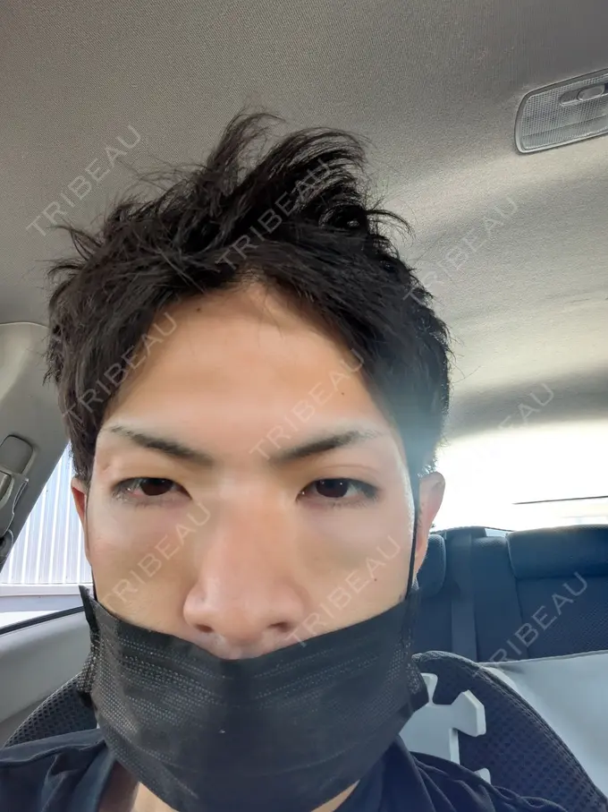 クマ治療 ネビュラクリニック 東京錦糸町院 AFTER メイン用