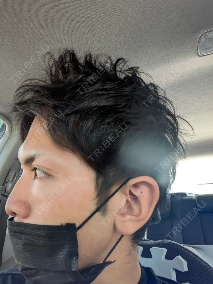 クマ治療 ネビュラクリニック 東京錦糸町院 DAY 1 メイン用