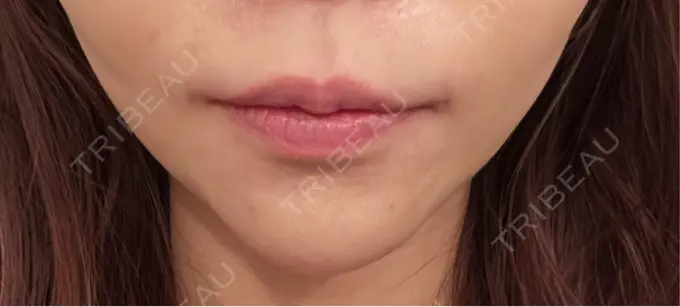 ボトックス（あご） 湘南美容クリニック 名古屋院 DAY 6 メイン用