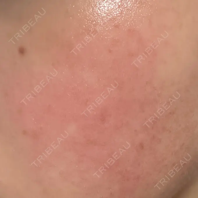 イオン導入 / ルメッカ ルラ美容クリニック 仙台院 / ルラスキンクリニック 仙台院 AFTER メイン用