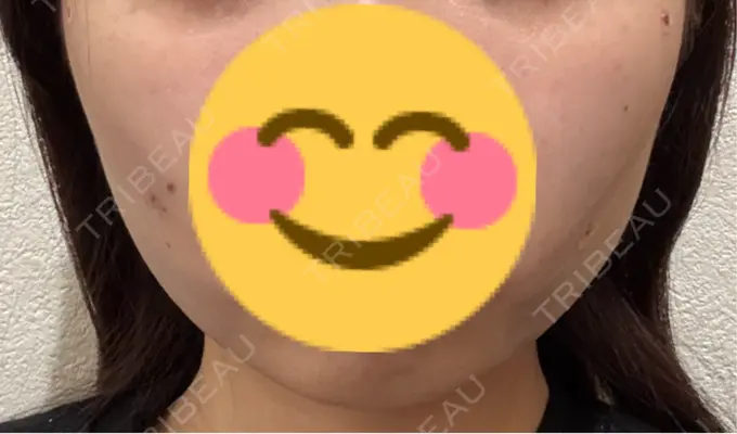 糸リフト / 脂肪吸引（顔） / 脂肪吸引注射（顔） ziz CLINIC DAY 0 メイン用