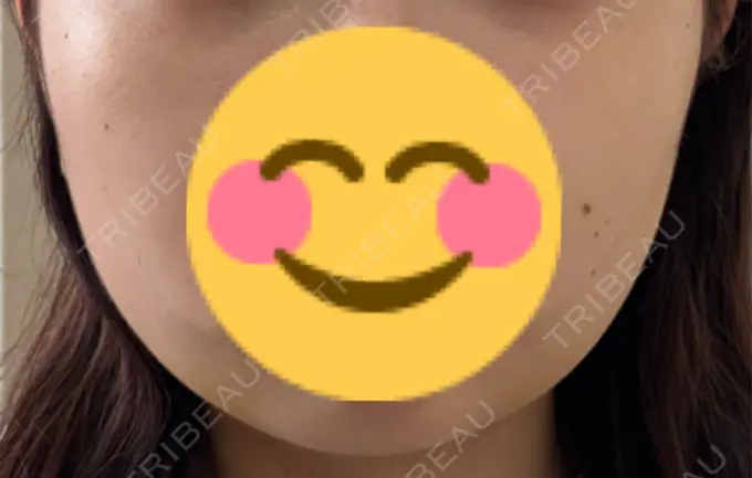 糸リフト / 脂肪吸引（顔） / 脂肪吸引注射（顔） ziz CLINIC AFTER メイン用