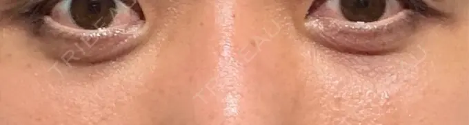 クマ治療 藤・ナチュレ美容クリニック 銀座院 AFTER メイン用