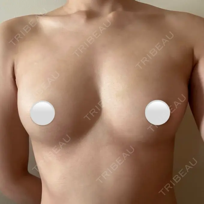 脂肪吸引（脚） / 豊胸（脂肪注入） 湘南美容クリニック Regno 銀座院 AFTER メイン用